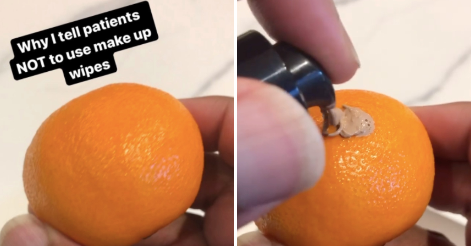 Cosmetic doctor shares video on why people shouldn't use makeup wipes VT