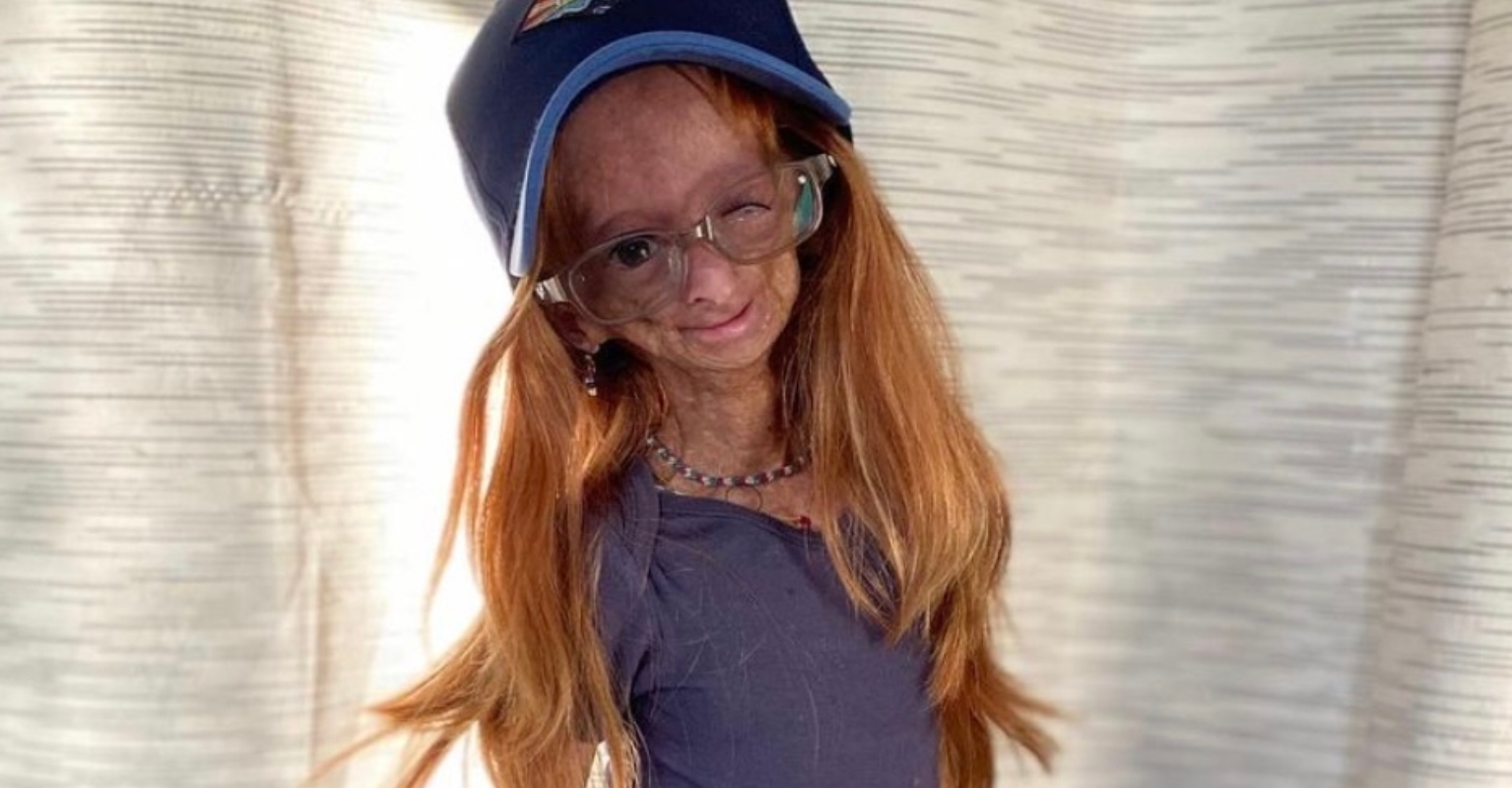 YouTube star Adalia Rose Williams dies aged 15