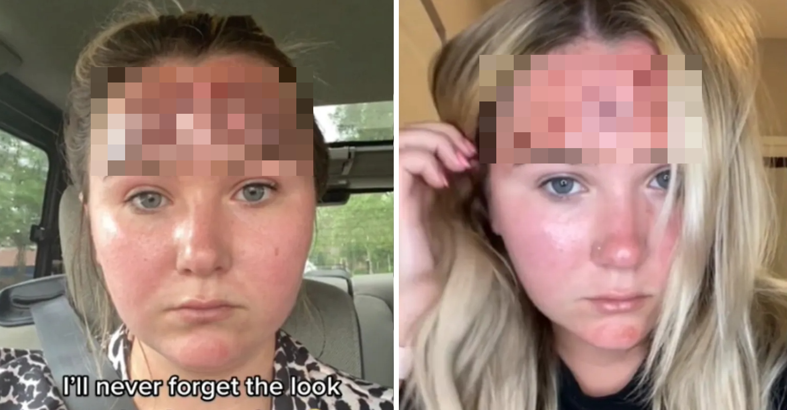 Woman Shares Second degree Burns After Using Expired Sunscreen VT