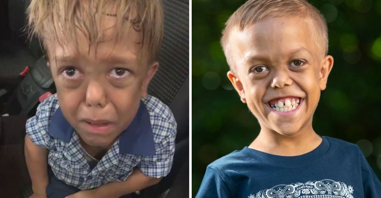 Bullied Boy With Dwarfism Cast In New 'Mad Max' Movie