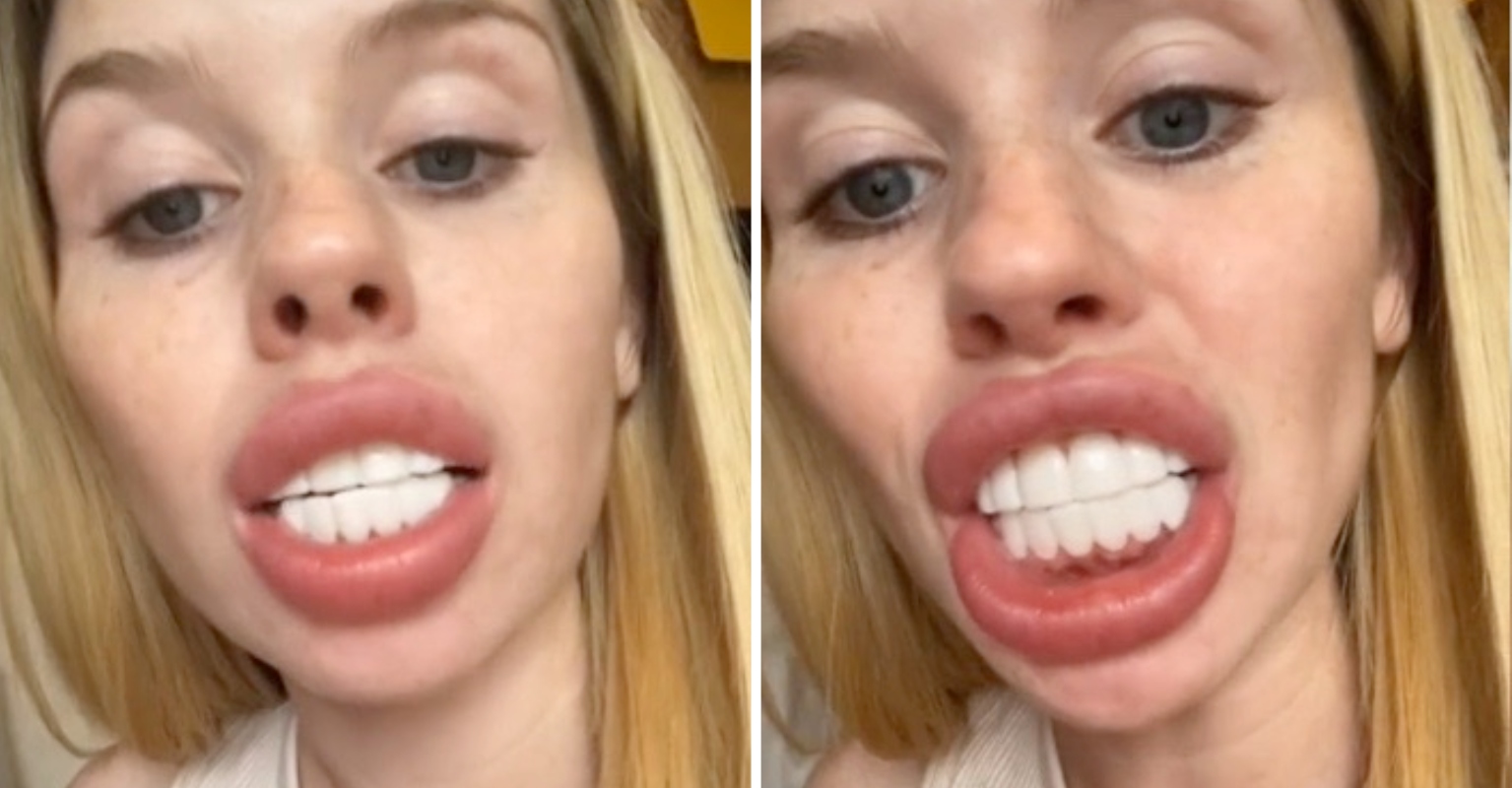 Woman Goes Viral After Showing Off Veneers She Days Left Her Looking