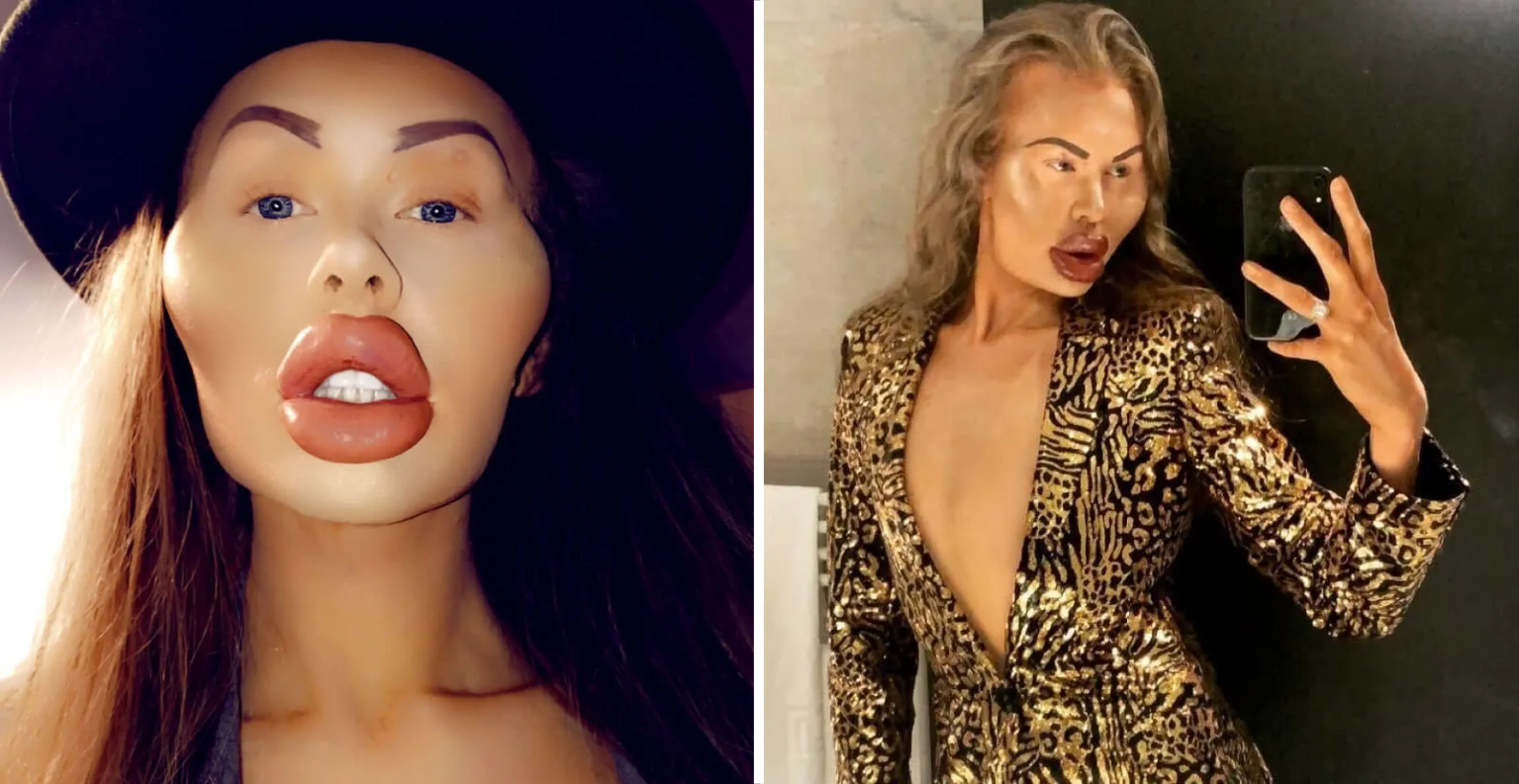 Self Confessed Filler Addict Claps Back At Haters Who #39 Stare #39 And