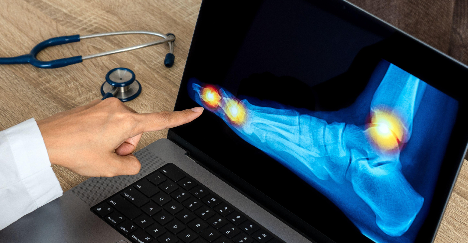 TikToker gets toe-shortening surgery after years of feeling insecure about her feet