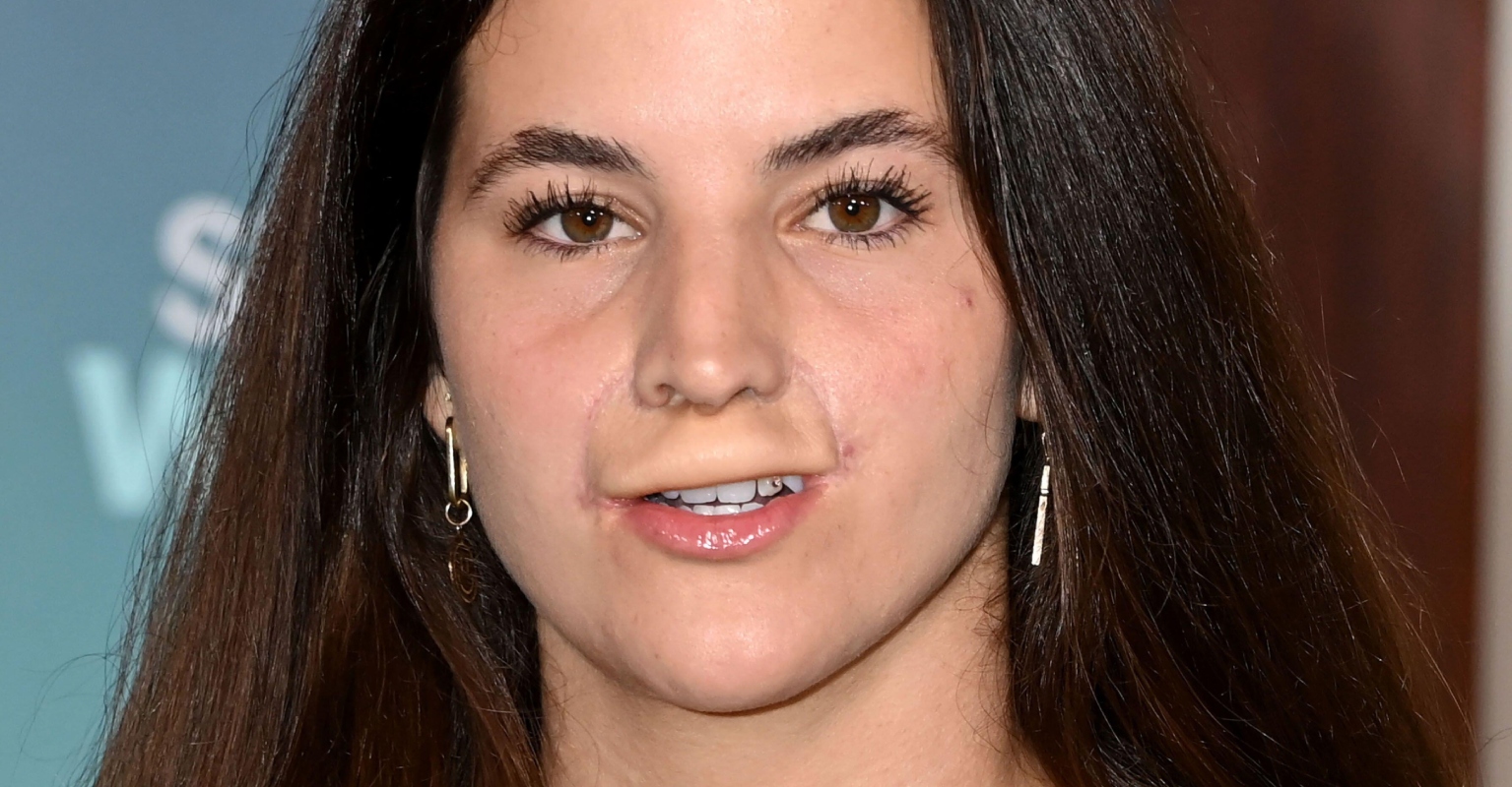 Skateboarder defends her doctors after trolls criticize reconstructive surgery after dog attack
