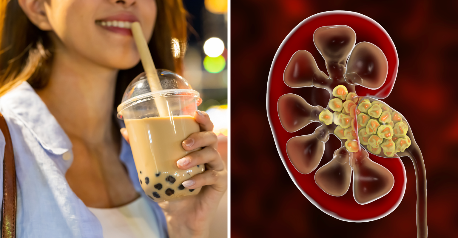 Doctors Reportedly Remove '300 Kidney Stones' From 20YearOld Woman